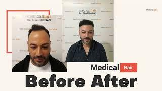 Hair Transplant - Before After Results [Best Results]