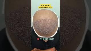 Hair Loss Treatment #hair #hairloss #hairlosstreatment #ytshorts #alopecia #hairtransplant #hairfall