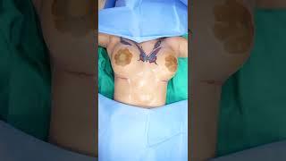 Breast implant Result | Breast Implant Surgery cost | Breast Augmentation result #shorts