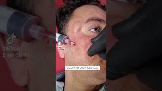 Scar subcision with nokor needle علاج الندبات العميقة عن طريق تقطيع التليفات في الجلد