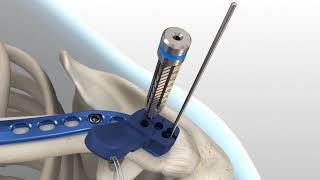 Acumed - Acu-Sinch Surgical Technique