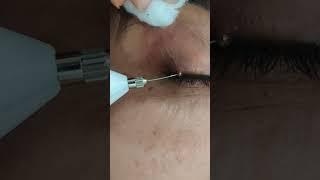 Milia Removal / Dr. Sanchika Gupta ‍️