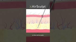 AirSculpt Medical Questions