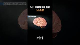 노인 우울증으로 인한 뇌 손상