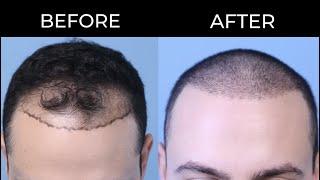 FUE HAIR TRANSPLANT BEFORE AND AFTER