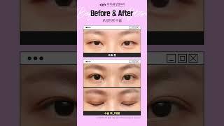40대 상안검수술 후기 처진눈꺼풀을 자연스럽게 개선