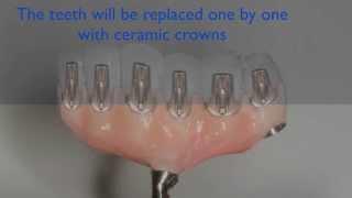 Cad Cam - screw retained dento-alveolar prostheses