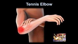 Tennis Elbow,  why it hurts?  Everything You Need To Know - Dr. Nabil Ebraheim