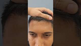 6th Month post Hair Transplant...fabulous transformation..