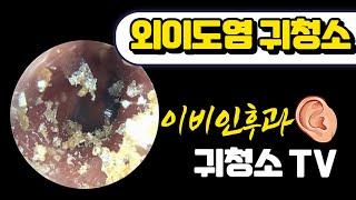 외이도염 귀청소 (ear wax removal)