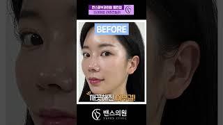 기존 리쥬란힐러 VS 프리미엄 리쥬란힐러 반반시술로 통증 비교해드립니다!