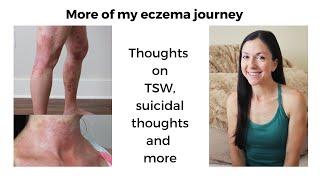 Eczema and topical steroid withdrawal (TSW) | My experience