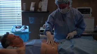 Vaser Liposuction  - SmartLipo