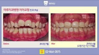 치아교정 전후 사례 [마루치과병원/치아교정사례]