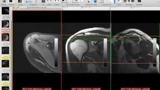 Systematic Interpretation of Shoulder MRI: How I do it