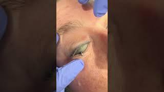 Would you do this to protect eyes before laser treatment on eyelids? #dermatologist