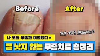 발톱 무좀치료 어디까지 알고계신가요?
