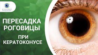 Сквозная кератопластика (пересадка роговицы глаза) в Москве - клиника доктора Шиловой