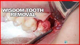 Double Wisdom Tooth Extraction. Surgical Guide: Online Course + Free e-Book!