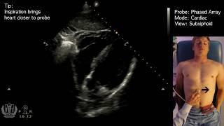 Subxiphoid View - Transthoracic Ultrasound (Echocardiography)