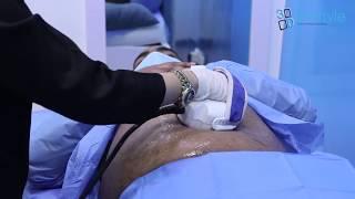 Lose ONE inch in just 45 Minutes by 3D Bespoke Non-Surgical Fat Melting Procedure - 3D Cavitation