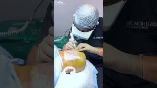 Best Price for Hair Transplant in India at Cara Clinic 2024