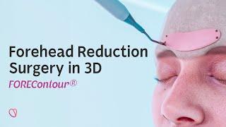 FOREContour® — Forehead Reduction Surgery in 3D