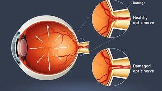 Advancements in Restoring Optic Nerve Function - Beyond Cell Regeneration