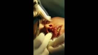 Bulhorn chiloplasty - the operation takes place | Dr. Zykov