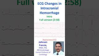 ECG Changes in Intracranial Hemorrhage