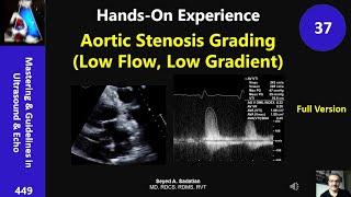 Hands-On Experience 37: Aortic Stenosis Grading (Low Flow, Low Gradient)