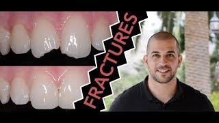 How to Repair a Broken Tooth with Dentist Filling (Dentist)