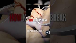Here's The Worst Way To Fracture Your Kneecap⁉️