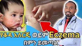 የቆዳ አለርጂ ወይም Eczema በምን ይመጣል | What causes skin allergy or eczema | Dr. Fasil