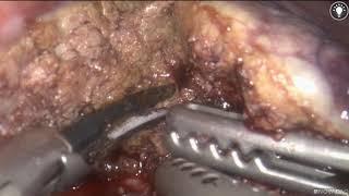 『肝癌』基隆一般外科全腹腔鏡左肝腫瘤切除手術 Pure laparoscopic lateral segmentectomy