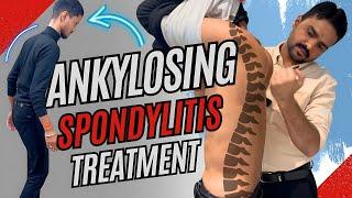 How Chiropractor Help Manage Ankylosing Spondylitis | Dr. Harish Grover