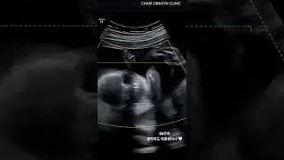 태아 하품영상
