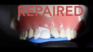 How the dentist repairs a chipped tooth