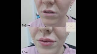 Lip filler / augmentation @ Skinox