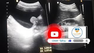 Elongated Cervix   Endometrial polyp   Enlarged Pancreas   Enlarged Pancreas 1   Enlarged Prostate w