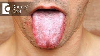 Is Oral Candidiasis related to HIV status? - Dr. Mohammed Fayaz Pasha