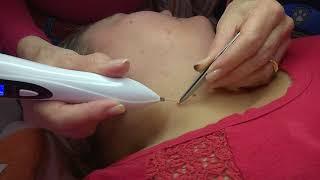 Training video for skin tag removal using the Plasma Pen