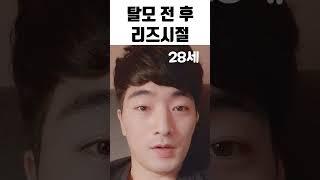 대머리 탈모 전 후 리즈시절 #shorts