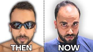 Hair Transplant OR Head Shave? - Making My Choice