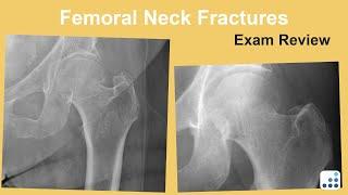 Femoral Neck Fractures Exam Review - Bohannon Mason, MD