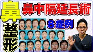 鼻の整形【鼻中隔延長術とこれまでの鼻尖形成との違い】鼻中隔延長術８症例紹介