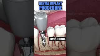 Smile Influencers | Tooth Implant Process - Dental Surgeon Hub