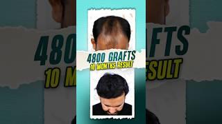 Hair Transplant in Bangladesh (4800 Grafts) #hairtransplant #hair #bangladesh #shorts