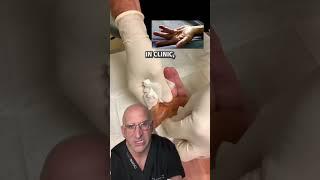 Listen for the POP DUPUYTREN’S Contracture Quick Fix #shorts