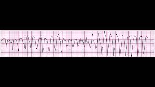 Torsades de Pointes 200bpm (polymorphic ventricular tachycardia)